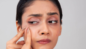 পিম্পল